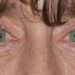 Blepharoplasty Before & After Patient #2527