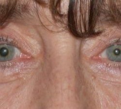 Blepharoplasty Before & After Patient #2527