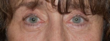 Blepharoplasty Before & After Patient #2527