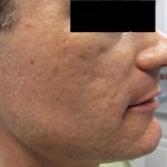 Fractional CO2 Laser Before & After Patient #2648