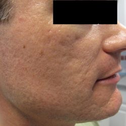 Fractional CO2 Laser Before & After Patient #2648