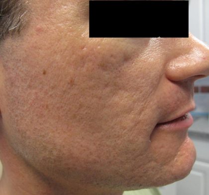 Fractional CO2 Laser Before & After Patient #2648