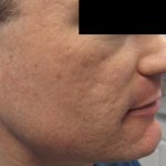 Fractional CO2 Laser Before & After Patient #2648