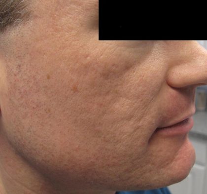 Fractional CO2 Laser Before & After Patient #2648