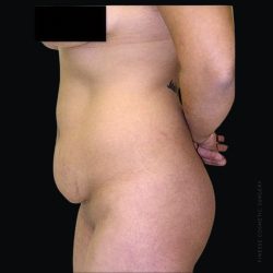 Tummy Tuck Before & After Patient #2503