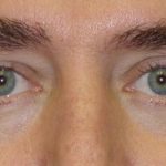 Blepharoplasty Before & After Patient #2528