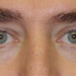 Blepharoplasty Before & After Patient #2528