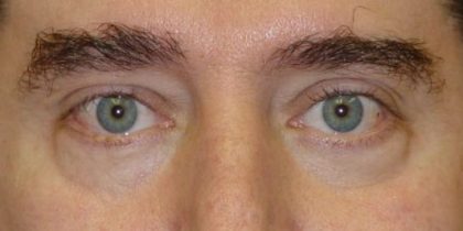 Blepharoplasty Before & After Patient #2528