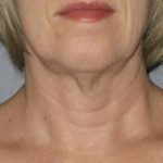 Ultherapy Before & After Patient #2711