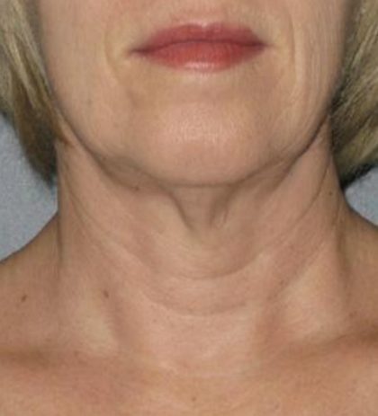 Ultherapy Before & After Patient #2711