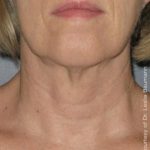 Ultherapy Before & After Patient #2711