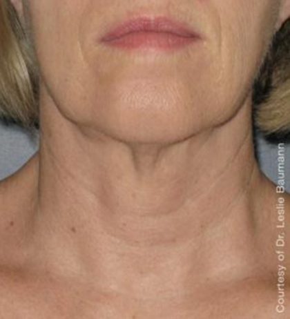 Ultherapy Before & After Patient #2711