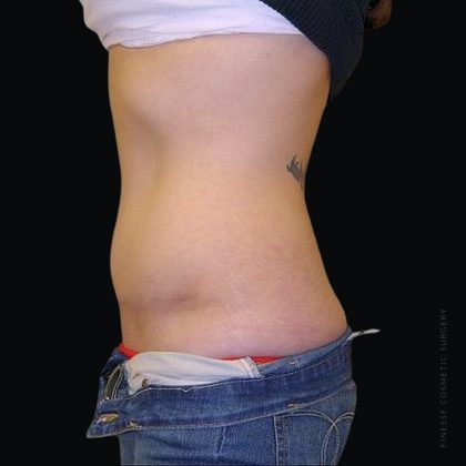 Tummy Tuck Before & After Patient #2503