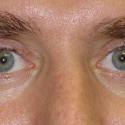 Blepharoplasty Before & After Patient #2528