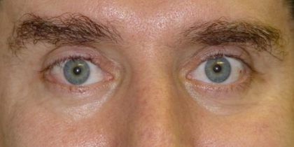 Blepharoplasty Before & After Patient #2528