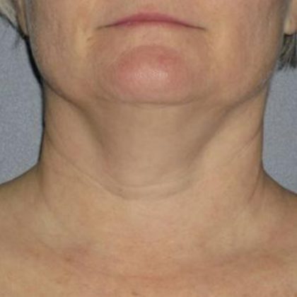 Ultherapy Before & After Patient #2712