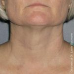 Ultherapy Before & After Patient #2712