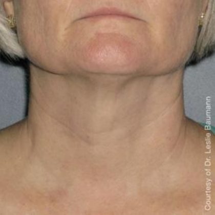 Ultherapy Before & After Patient #2712