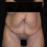 Tummy Tuck Before & After Patient #2504
