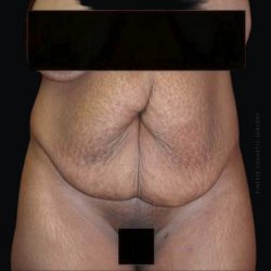 Tummy Tuck Before & After Patient #2504