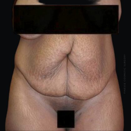 Tummy Tuck Before & After Patient #2504