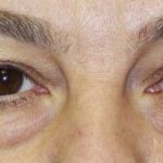 Blepharoplasty Before & After Patient #2529