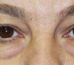 Blepharoplasty Before & After Patient #2529
