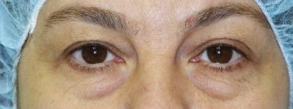 Blepharoplasty Before & After Patient #2529
