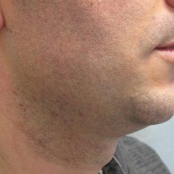 Fractional CO2 Laser Before & After Patient #2646