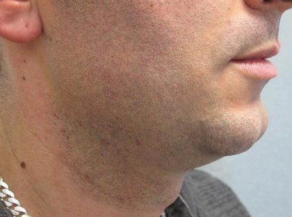 Fractional CO2 Laser Before & After Patient #2646