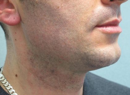Fractional CO2 Laser Before & After Patient #2646