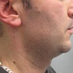 Fractional CO2 Laser Before & After Patient #2646