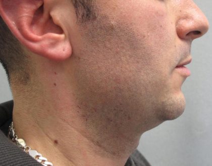 Fractional CO2 Laser Before & After Patient #2646