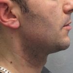 Fractional CO2 Laser Before & After Patient #2646