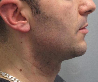 Fractional CO2 Laser Before & After Patient #2646
