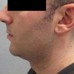 Fractional CO2 Laser Before & After Patient #2646