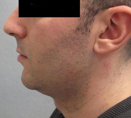 Fractional CO2 Laser Before & After Patient #2646