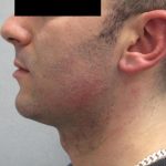 Fractional CO2 Laser Before & After Patient #2646