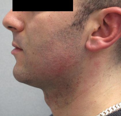 Fractional CO2 Laser Before & After Patient #2646