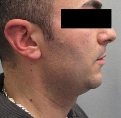 Fractional CO2 Laser Before & After Patient #2646
