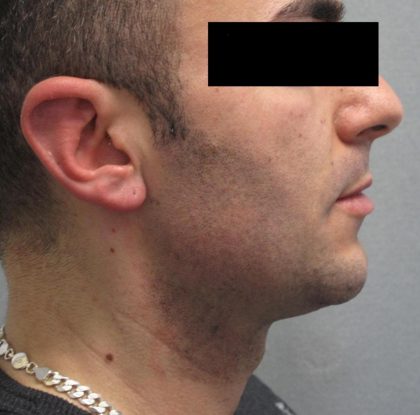 Fractional CO2 Laser Before & After Patient #2646
