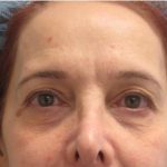 Fractional CO2 Laser Before & After Patient #2647