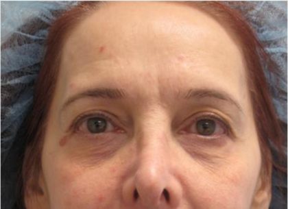 Fractional CO2 Laser Before & After Patient #2647