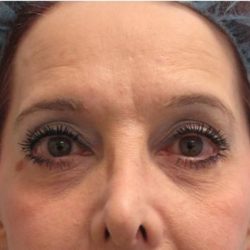 Fractional CO2 Laser Before & After Patient #2647