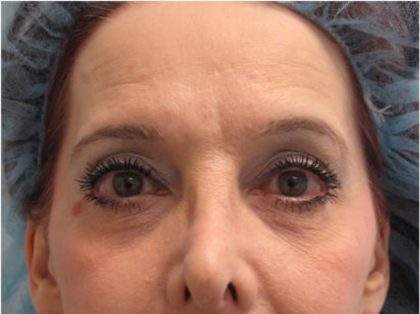 Fractional CO2 Laser Before & After Patient #2647