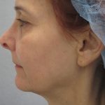 Fractional CO2 Laser Before & After Patient #2647