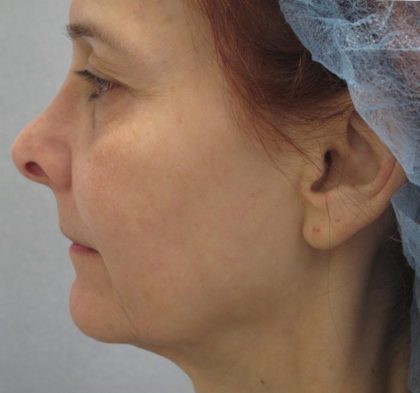 Fractional CO2 Laser Before & After Patient #2647