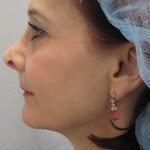 Fractional CO2 Laser Before & After Patient #2647