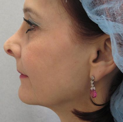 Fractional CO2 Laser Before & After Patient #2647