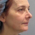 Fractional CO2 Laser Before & After Patient #2647